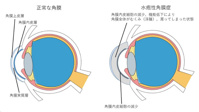 【慶應義塾】世界初となる水疱性角膜症に対するヒトiPS細胞由来角膜内皮代替細胞移植の第1例目を実施