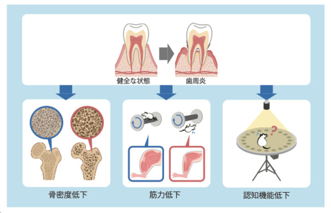 【慶應義塾】歯周炎による炎症は老化を促進して各種臓器の障害を招く