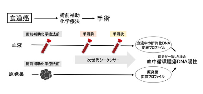 【慶應義塾】手術前の血液中から食道癌の予後を予測できることを発見