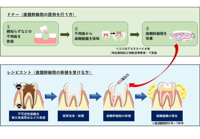 国内初となる他人の歯髄幹細胞を用いた「歯髄再生治療」の臨床研究を開始