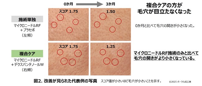 美容医療施術とデクスパンテノールW配合製剤の複合ケアで安全性と有効性を実証