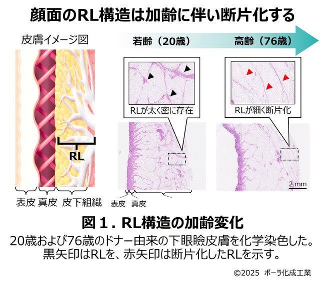 皮下深部の「Retaining Ligament（RL）」がたるみと関連