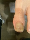 目立たない矯正器具 目立たない矯正器具