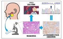  【東京医科大学】高悪性度唾液腺癌の予後因子となる新規のがん抑制遺伝子発現様式を発見 ～多施設共同研究によるp53タンパク細胞質発現パターンとTP53遺伝子変異の相関を解明～