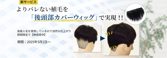 「植毛バレ」を防ぐ新提案！専用カバーウィッグ、無償提供スタート