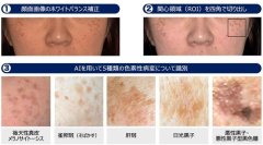 AIを用いた顔のシミの高精度診断支援システム開発に成功　レーザー治療実施判断を支援し、治療の最適化に期待
