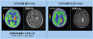 【横浜市立大学】脳悪性リンパ腫の遺伝子異常を判定する画像検査法を開発