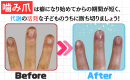 バイバイ！噛み爪_Before＆After
