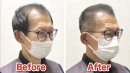 U字薄毛をカットで改善(2)