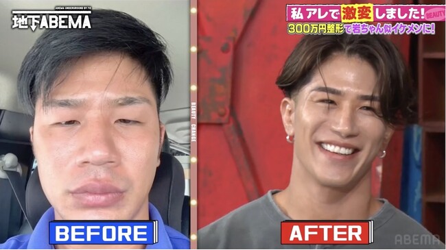 ビフォーアフター動画が1000万再生超え！整形費用300万円で岩田剛典似に“激変”した男性が「やって良かった整形」を告白＆整形後の驚愕体験をぶっちゃけ｜『ななにー 地下ABEMA』#84