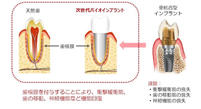 次世代バイオインプラント、FDA申請で米企業と提携