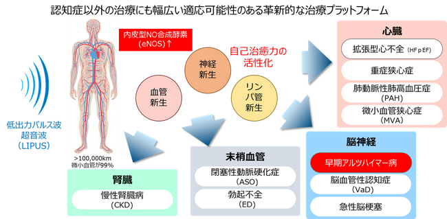 早期アルツハイマー病治療装置の研究開発を手掛けるサウンドウェーブイノベーションへの出資および業務提携契約の締結