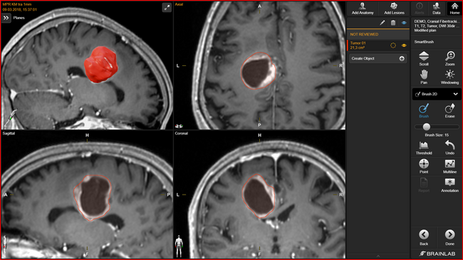 Brainlab(R) ElementsにAI技術を新たに搭載