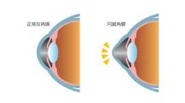 円錐角膜の模式図 円錐角膜の模式図