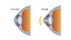 未成年の円錐角膜への角膜クロスリンキングの費用支援を開始しました