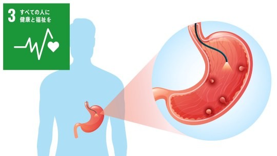 GAPPSにおける胃癌発生に関わる遺伝子変異の解明
