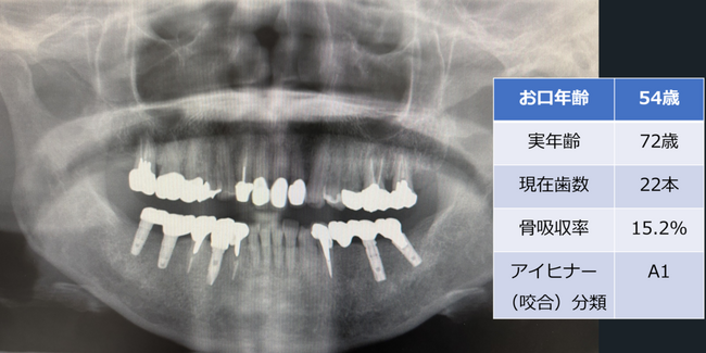 歯科エックス線画像を用いた「お口年齢AI」の開発について