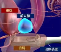 西日本初!先進医療 HIFU(ハイフ)を用いた前立腺がん局所療法を香大病院で開始