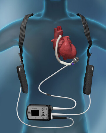 難治性心不全を救う!植込型左室補助人工心臓(LVAD)の最新治療報告会