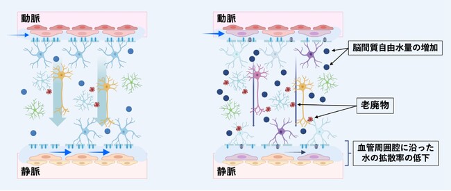 対側脳領域の脳間質液動態が膠芽腫患者の生存期間を予測