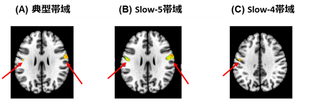 社交不安症患者の脳活動に新発見～感覚処理領域の活動低下が認知機能障害と関連～