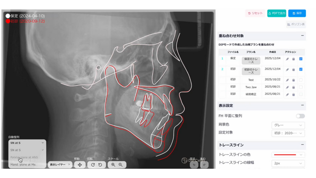 AIが矯正歯科の「重ね合わせ」解析を完全自動化　クラウド型AIセファロ分析システム「DIP Magic Compare(TM)」正式リリース