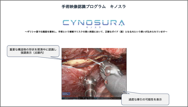 Direava株式会社、AI搭載 「手術映像認識プログラム キノスラ」が薬事承認を取得～手術中の重要神経のリアルタイム認識と牽引表示で、合併症低減を目指す