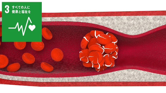 世界初!血液の“固まりやすさ”を検出する血液検査SMAT (スマット) の開発-抗凝固薬の使用や疾患ごとの血の固まりやすさを見える化-