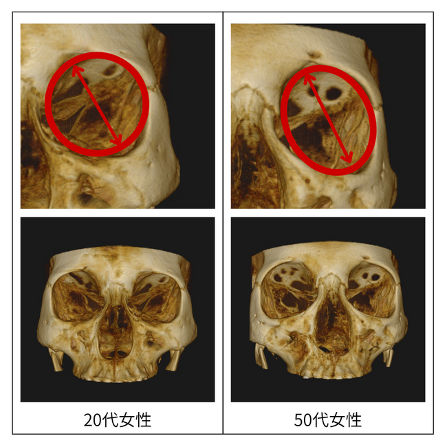 顔のたるみは「肌」ではなく「骨」が原因!?