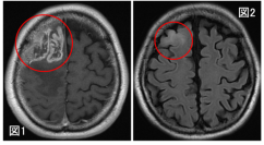 膠芽腫の画像起源の解明~いつから腫瘍は存在していたのか?~(北里大学)