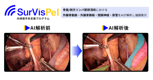 Jmeesと国立がん研究センター東病院が共同開発した「内視鏡手術支援プログラム SurVis-Pel」が薬事承認を取得