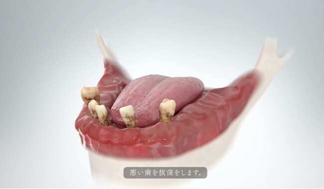 入れ歯の時代が終わる。歯科界に革命をもたらす新治療「オールオンX」のイメージCG完成。