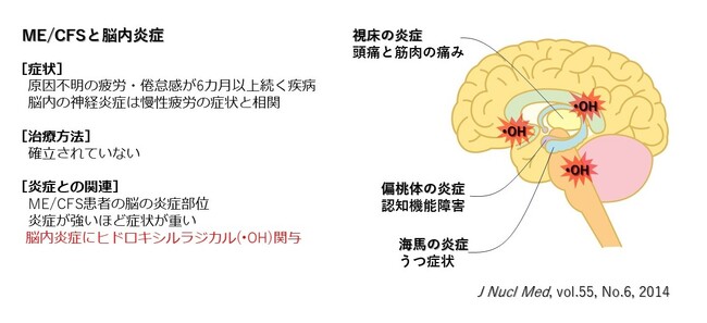 低濃度水素吸入による筋痛性脳脊髄炎／慢性疲労症候群（ME/CFS）改善のメカニズム