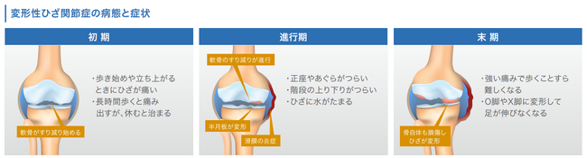 【医療法人社団活寿会×神戸大学】ひざ再生医療の「効果の鍵」を特定｜共同研究論文が国際学術誌に掲載