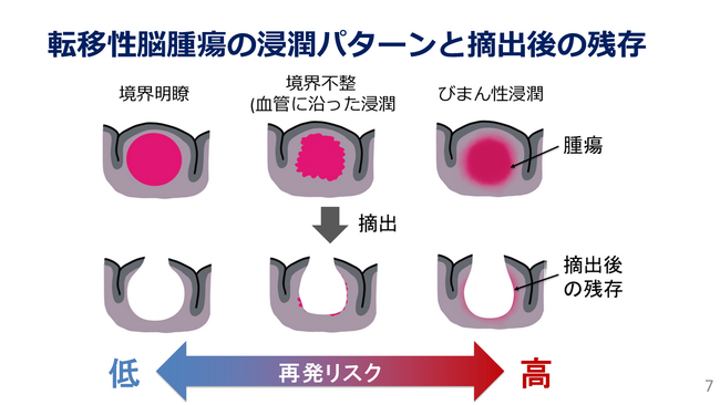 転移性脳腫瘍に対する光線力学的療法の有効性を評価する第II相臨床試験を先進医療Bで開始