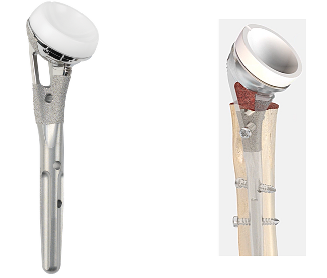 日本ストライカー 人工肩関節システム「Tornier Perform Fracture」を発売