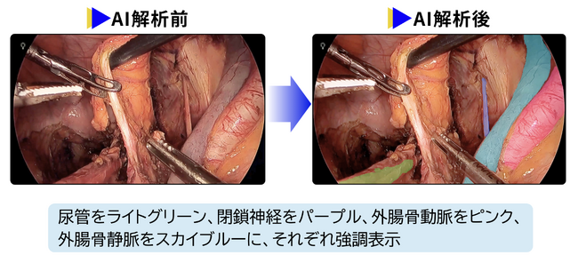 骨盤リンパ節郭清を支援する手術AIの有用性を外科医36名で実証 ―国際医学誌「npj Digital Medicine」に研究成果を発表―