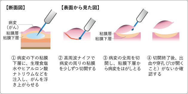 未分化型早期胃がんに対する内視鏡治療（ESD）の有効性を10年間の長期にわたる経過観察で検証～未分化型も内視鏡治療で胃の温存が可能～
