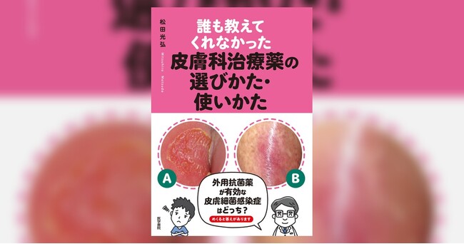 皮疹の背景にある病態、治療薬選択のコツと使い方を徹底解説！書籍『誰も教えてくれなかった皮膚科治療薬の選びかた・使いかた』8/10発売