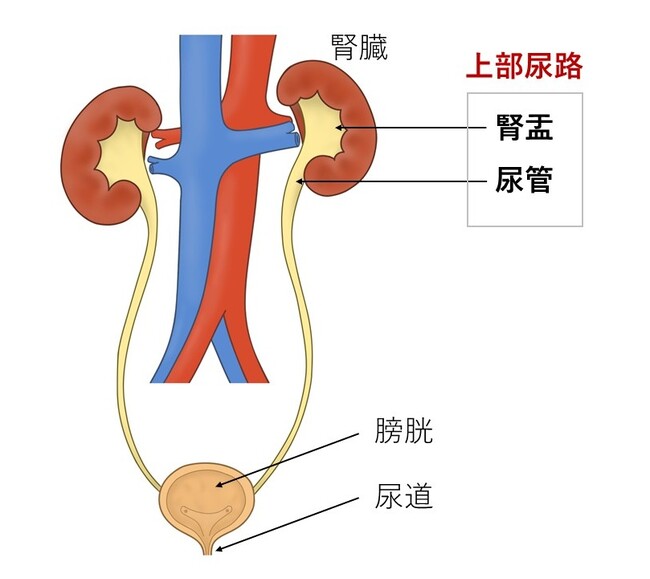 上部尿路（腎盂・尿管）がん術後の膀胱内再発予防にピラルビシン膀注療法が有効であることを証明